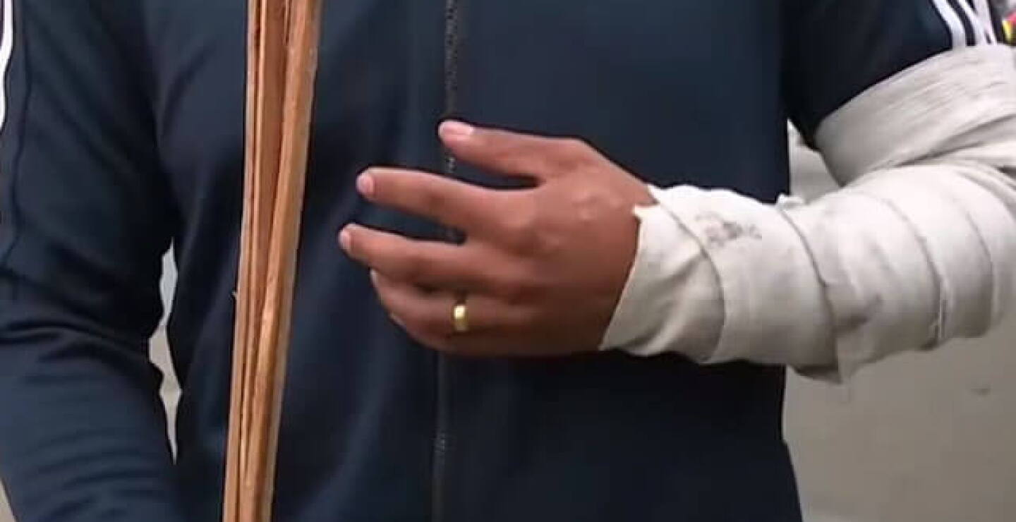 Imagen de referencia quemados con pólvora.