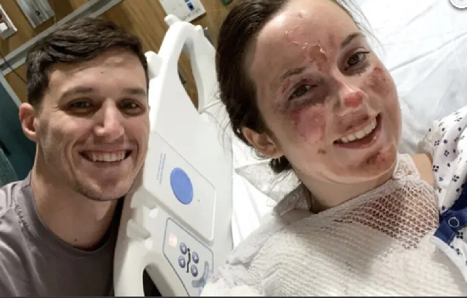 Joven debió cancelar su boda tras resultar con fuertes quemaduras: “Se me derritió la cara”