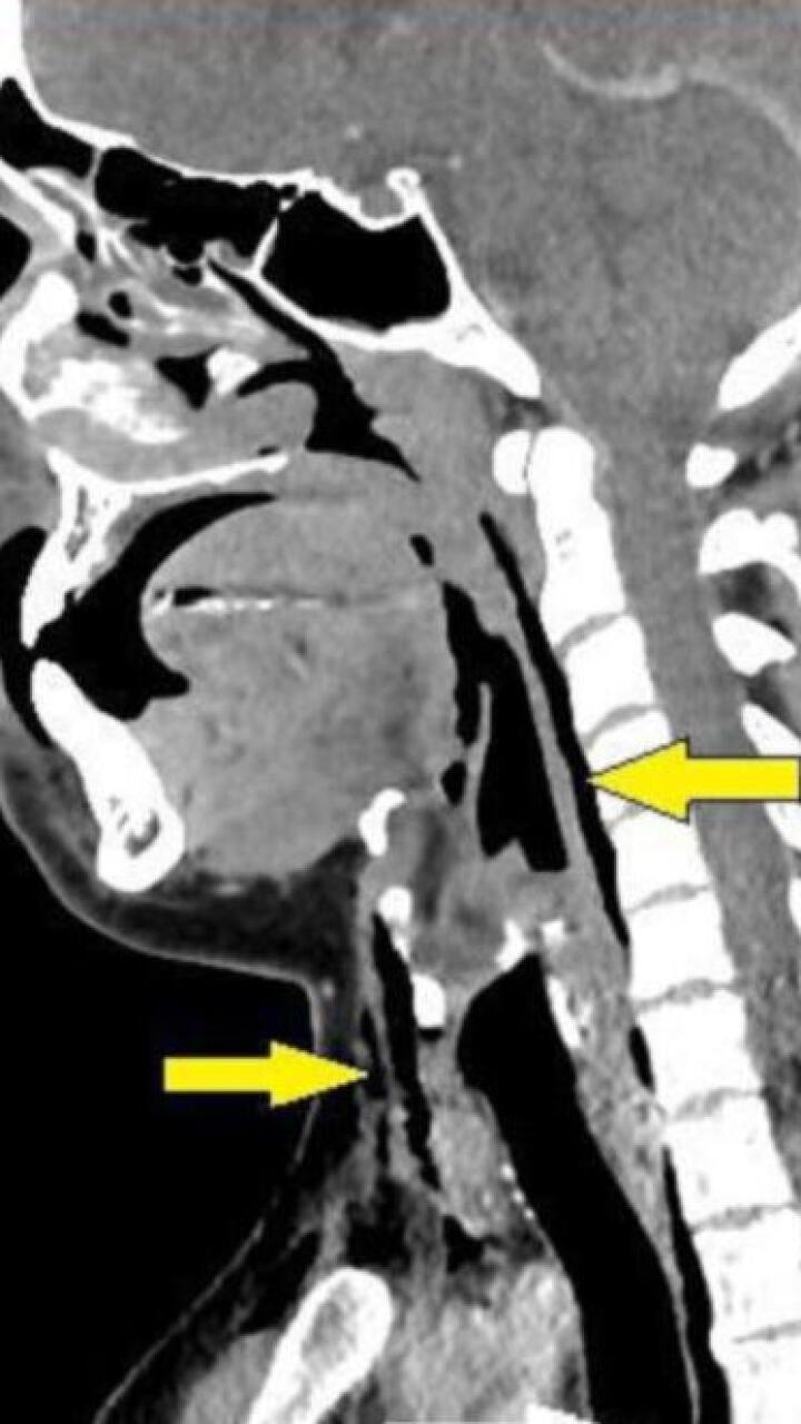 Por aguantar un estornudo, hombre terminó con la tráquea perforada