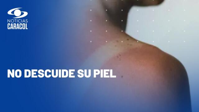 Consejos para evitar enfermedades en la piel durante las vacaciones Consejos para evitar enfermedades en la piel durante las vacaciones