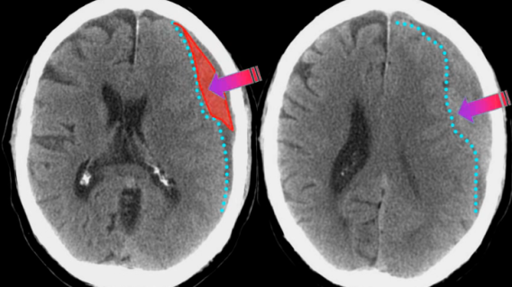 Hematoma Subdural de Maradona Hematoma Subdural de Maradona