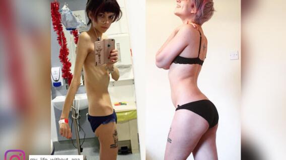 anorexia.jpg