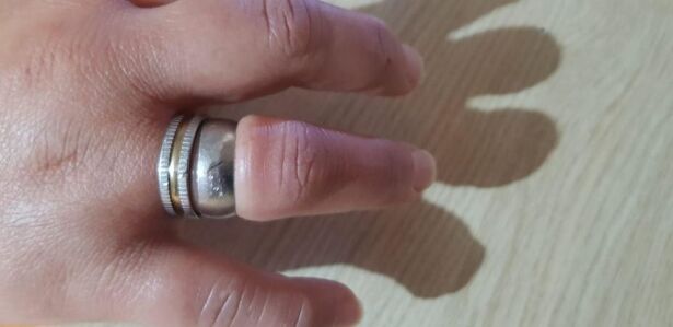ANILLO ATASCADO 2.jpg