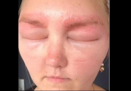 Alergia en la cara 2.jpg