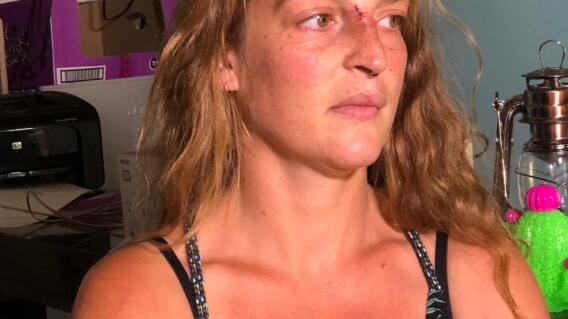 344987_BLU Radio// Turista golpeada en Cartagena. Foto: Cortesía