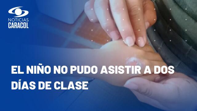 A niño de 5 años en Cali le quemaron las manos y la mamá es señalada como responsable A niño de 5 años en Cali le quemaron las manos y la mamá es señalada como responsable