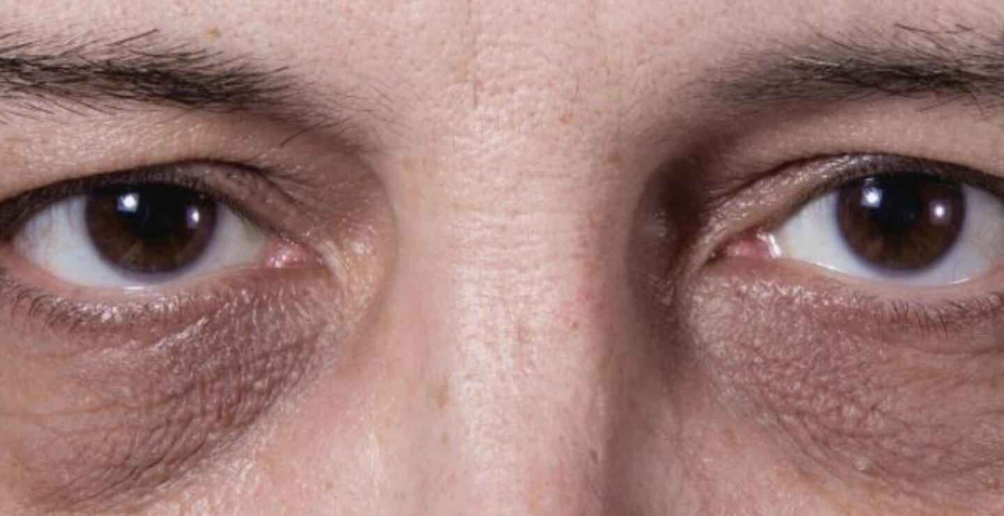 Ojeras