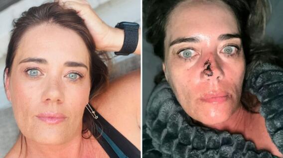 Por un grano en la nariz, una mujer de 52 años descubrió que tenía cáncer: “No dejaba de sangrar”