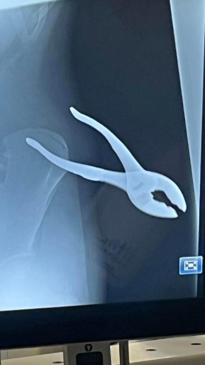 Adolescente se resbaló y terminó con unos alicates enterrados en la espalda