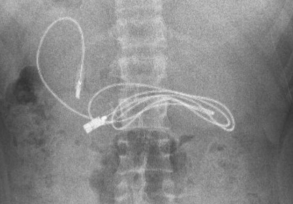 Cable USB encontrado dentro del estómago de un menor de 15 años 