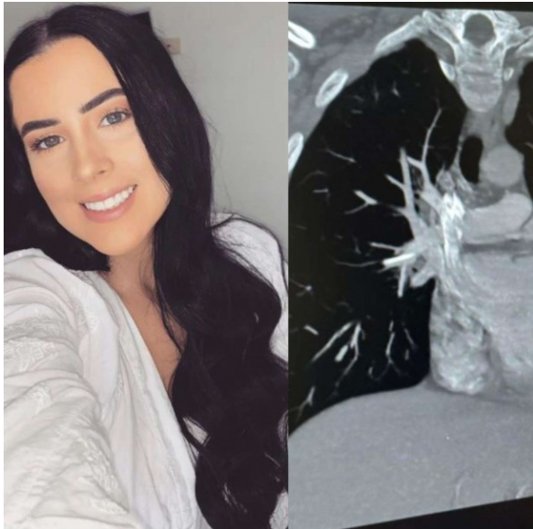 Mujer descubrió que su anticonceptivo se movió hasta su corazón Mujer descubrió que su anticonceptivo se movió hasta su corazón