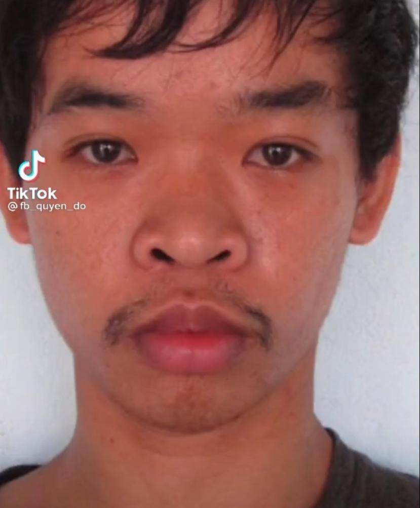 Joven Tiktoker, múltiples cirugías