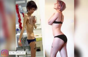 anorexia.jpg