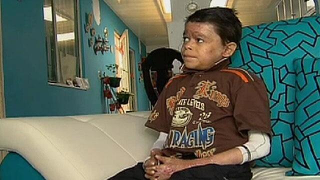 Murió el joven con piel de mariposa al que el papa bendijo durante su visita a Colombia