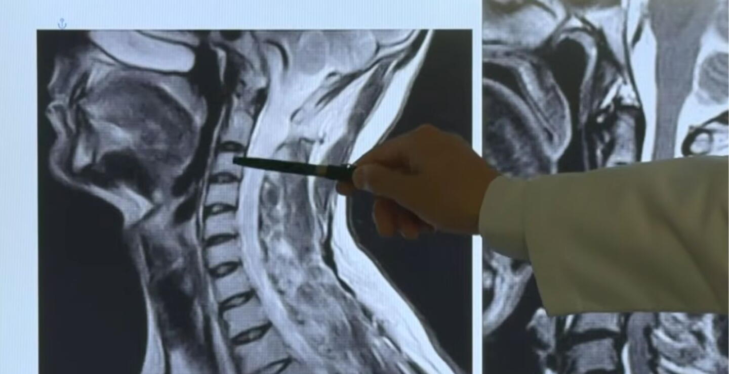 Alerta por síndrome de cuello de texto: este es el grave riesgo para la columna cervical