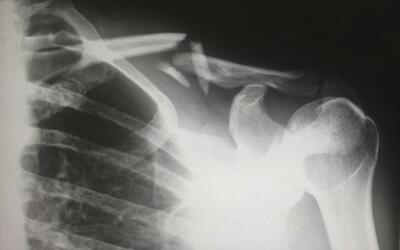 Lesiones y fracturas son las principales razones de consulta médica en vacaciones Lesiones y fracturas son las principales razones de consulta médica en vacaciones