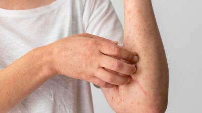 Alertan por aumento de casos de varicela en Colombia, según el INS: experta da recomendaciones