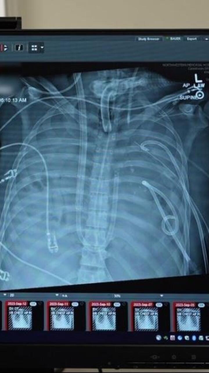 Hombre perdió ambos pulmones por usar vapeadores y gracias a implantes mamarios logró seguir con vida