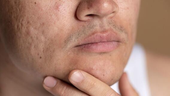 Riesgo de acné por uso de celular