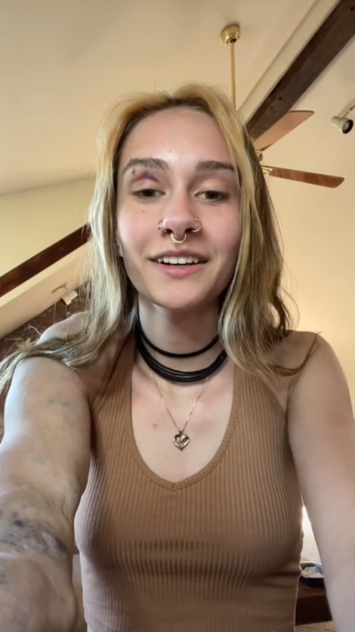 Joven que nació con malformación en su brazo asegura que internautas le aconsejan “amputárselo” 