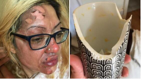 Tras utilizar un truco de TikTok para cocinar, una mujer resultó quemada en el rostro con un huevo.