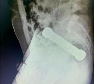 Hombre con pesa en el recto.jpg Hombre con pesa en el recto.jpg