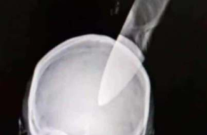 Mujer termina con cuchillo en la cabeza 