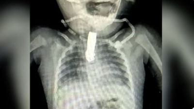 Bebé se tragó cortaúñas