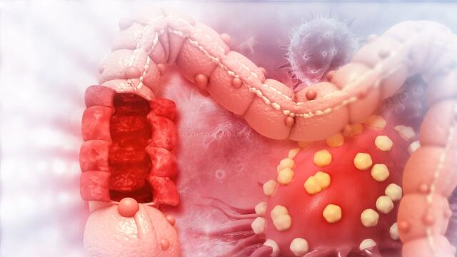 ¿Cuáles son las señales de alarma del cáncer de colon y recto? ¿Cuáles son las señales de alarma del cáncer de colon y recto?