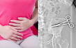 Mujer tuvo por varios meses unas tijeras en su cuerpo