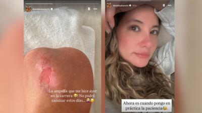 Daniela Álvarez mostró cómo le quedó su pierna tras su participación en la Media Maratón Bogotá
