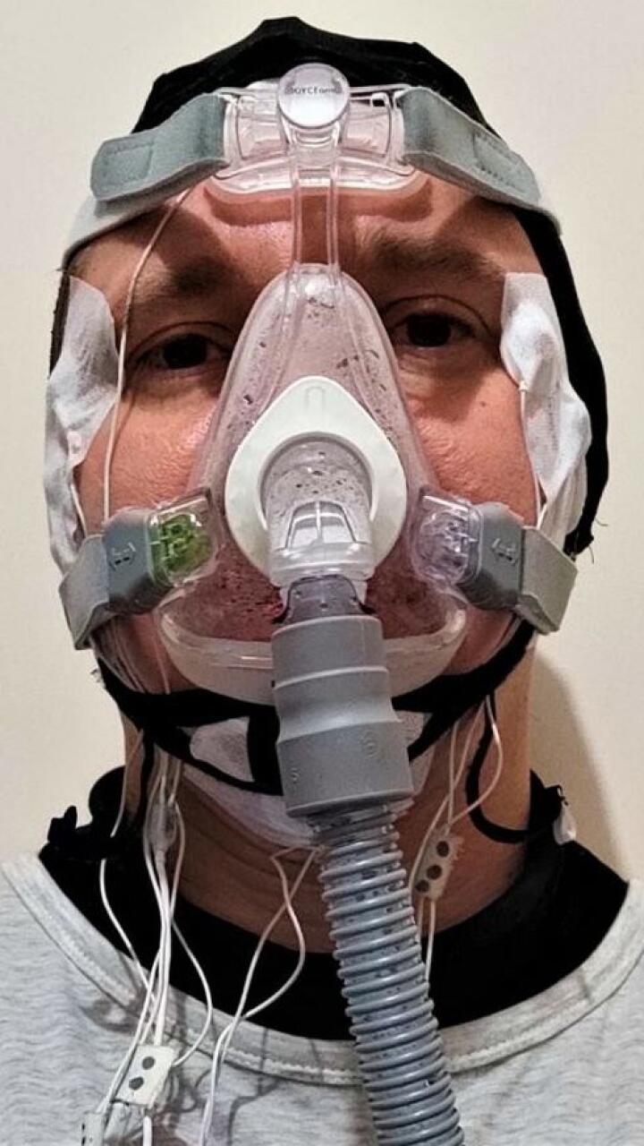 Hombre se perforó el cráneo para poder “controlar los sueños”