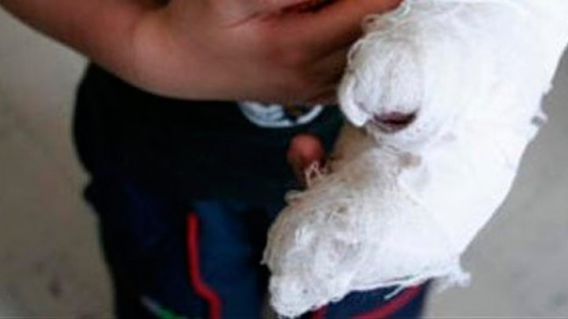 Niño sufre quemadura Niño sufre quemadura
