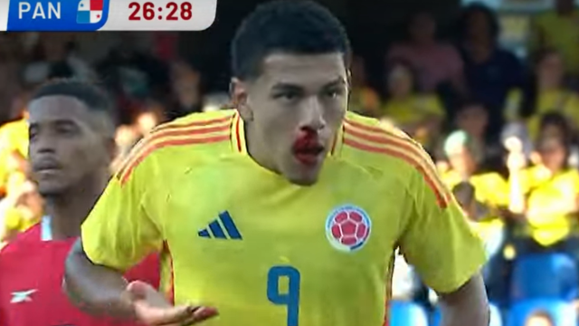 Emilio Aristizábal sangrando en duelo con la Selección Colombia Sub-20. Emilio Aristizábal sangrando en duelo con la Selección Colombia Sub-20.