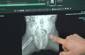 ¿Qué es la displasia de cadera y cómo tratarla a tiempo?