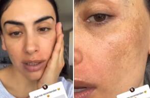 Jessica Cediel mostró su piel al natural y habló de la alergia en su rostro: “Mi mejor versión”