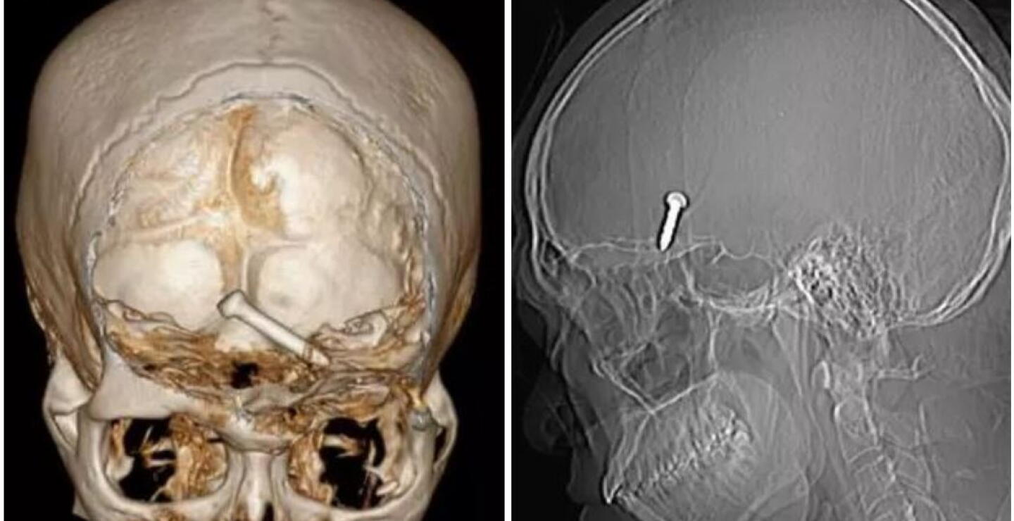 Gracias a este detalle hombre que se disparó en la cabeza con una pistola de clavos vivió para contarlo