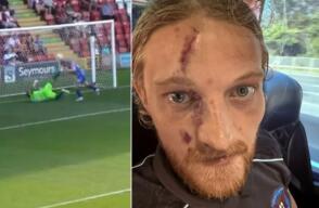 Futbolista sufrió dura patada en la cara en quinta división de Inglaterra.