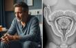 Conoce las formas de prevenir el cáncer de próstata