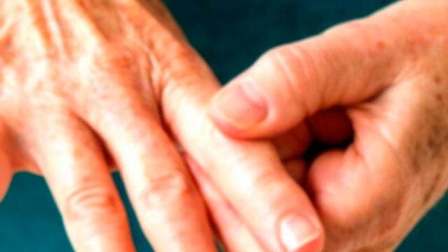 “El dolor es absolutamente terrible”: así es vivir con artritis, una enfermedad aún sin cura 