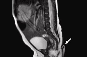 Radiografía de supuesta cola con la que nació una bebé 