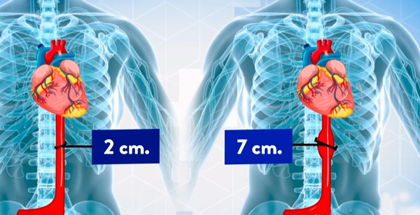 Cirugía aorta