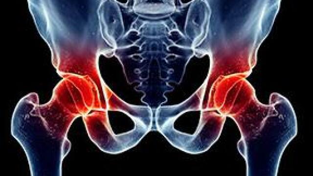 ¿Qué tan grave es fracturarse la pelvis?