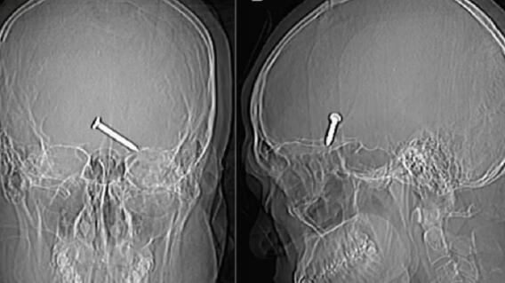 Un hombre de 30 años se disparó con una pistola de clavos y vivió para contarlo