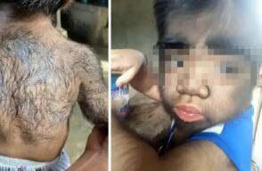 Niño más "peludo" del mundo Niño más "peludo" del mundo