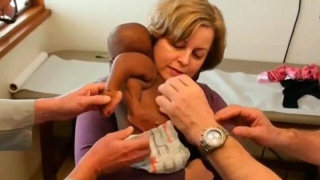 Exitosa cirugía a niña con cuatro piernas y dos columnas