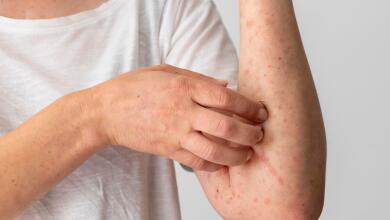 Alertan por aumento de casos de varicela en Colombia, según el INS: experta da recomendaciones