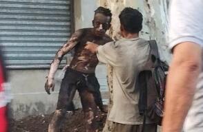 Hombre sufre quemaduras en el 90% de su cuerpo Hombre sufre quemaduras en el 90% de su cuerpo