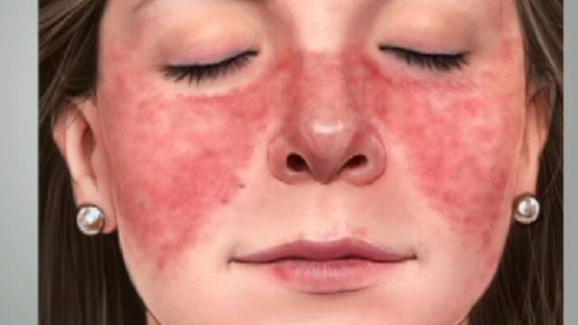 ¿Cómo detectar señales de alarma para saber si se sufre de Lupus? 