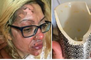 Tras utilizar un truco de TikTok para cocinar, una mujer resultó quemada en el rostro con un huevo.